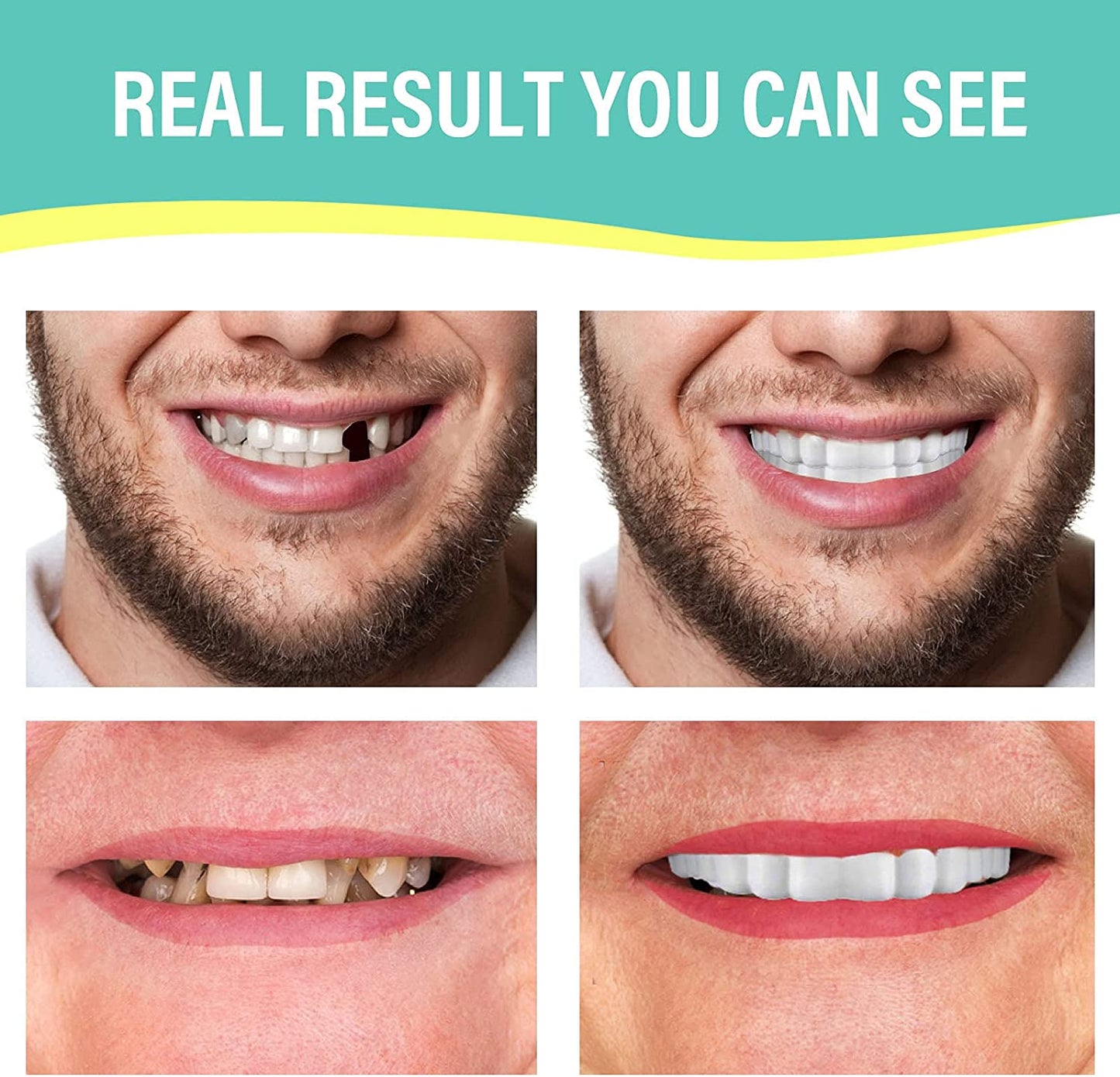 Smile Veneers Instant Snap-on Teeth Veneer - Upper & Lower Set