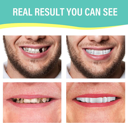 Smile Veneers Instant Snap-on Teeth Veneer - Upper & Lower Set